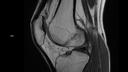 Sagittal PD DR Sharp-MAGNETOM Vida/Coil-Knee 18/Resolution-896/Scan Time-1:50/Aceleration-p3