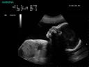 ACUSON P300 Ultrasound System - OB/GYN - Fetal Profile