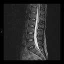 Sagittal T2-MAGNETOM Free.Max/Coil-Spine/Resolution-576/Scan Time-2:23/Aceleration-p2 DRS