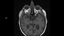 T1 TSE AX-MAGNETOM Sola/Coil-HeadNeck 20/Resolution-256/Scan Time-3:51/Aceleration-p2