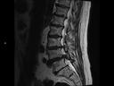 Sagittal T2 TSE-MAGNETOM Lumina/Coil-Spine 24/Resolution-384/Scan Time-3:22