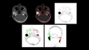 99mTc MDP SPECT/CT imaging in the evaluation of mandibular osteomyelitis severity