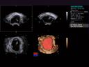 Hemorrhagic Ovarian Cyst imaging