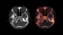 Increased uptake of 99mTc MDP in mastoid process of left temporal bone and cortical thickening with ground-glass density