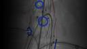 Stent deployment with fusion imaging