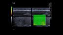 2D SWE Thyroid Mass Qualtiy Map