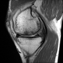 Sagittal PD TSE-MAGNETOM Altea/Coil-Knee18/Resolution-140 FoV/Aceleration-p2