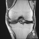 Coronal PD TSE-MAGNETOM Altea/Coil-Knee18/Resolution-140 FoV/Aceleration-p2