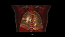 Biograph Vision clinical case