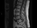 Sagittal T1 TSE-MAGNETOM Lumina/Coil-Spine 24/Resolution-768/Scan Time-3:42