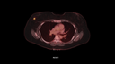 Biograph Vision clinical case