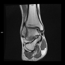 Coronal T1-MAGNETOM Free.Max/Coil-Contour Small/Resolution-400/Scan Time-3:47