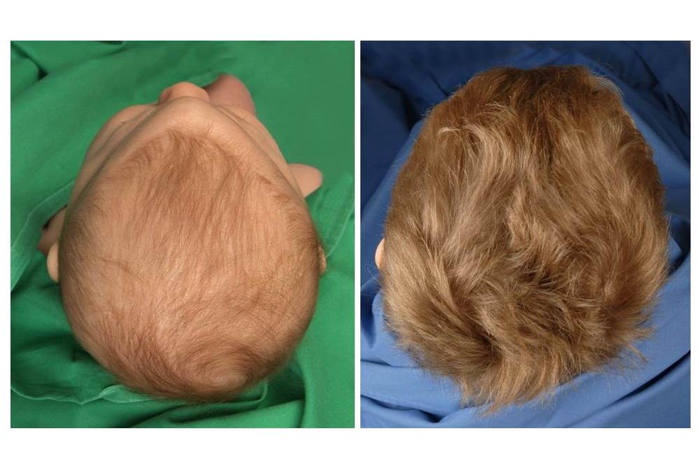 Kraniosynostose Kinderchirurgische Klinik und Poliklinik im Dr. von