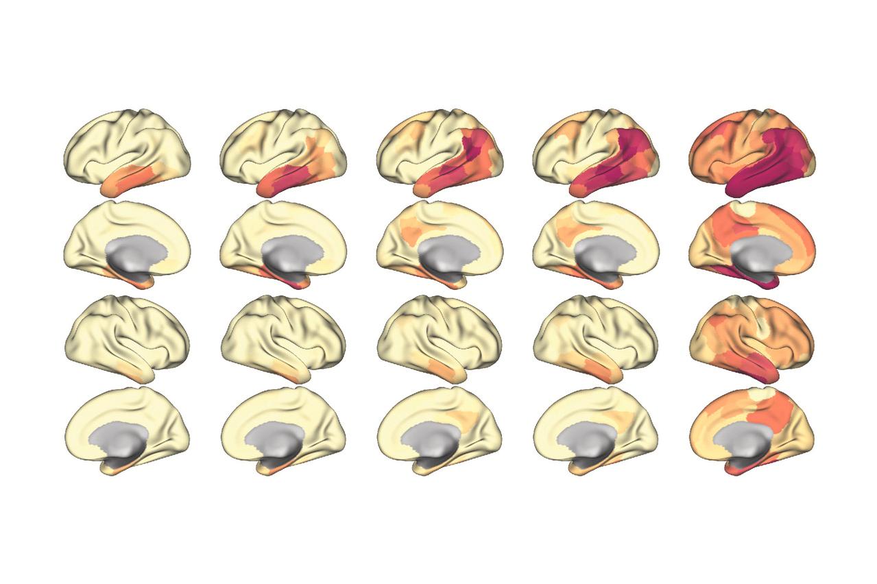 Beispiel für Tau-Ausbreitungsmuster bei Alzheimer
