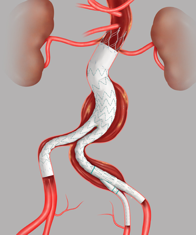 Current Eva R Evar Aortenreparatur Dauer – Endovaskuläre Reparieren – RUAUE
