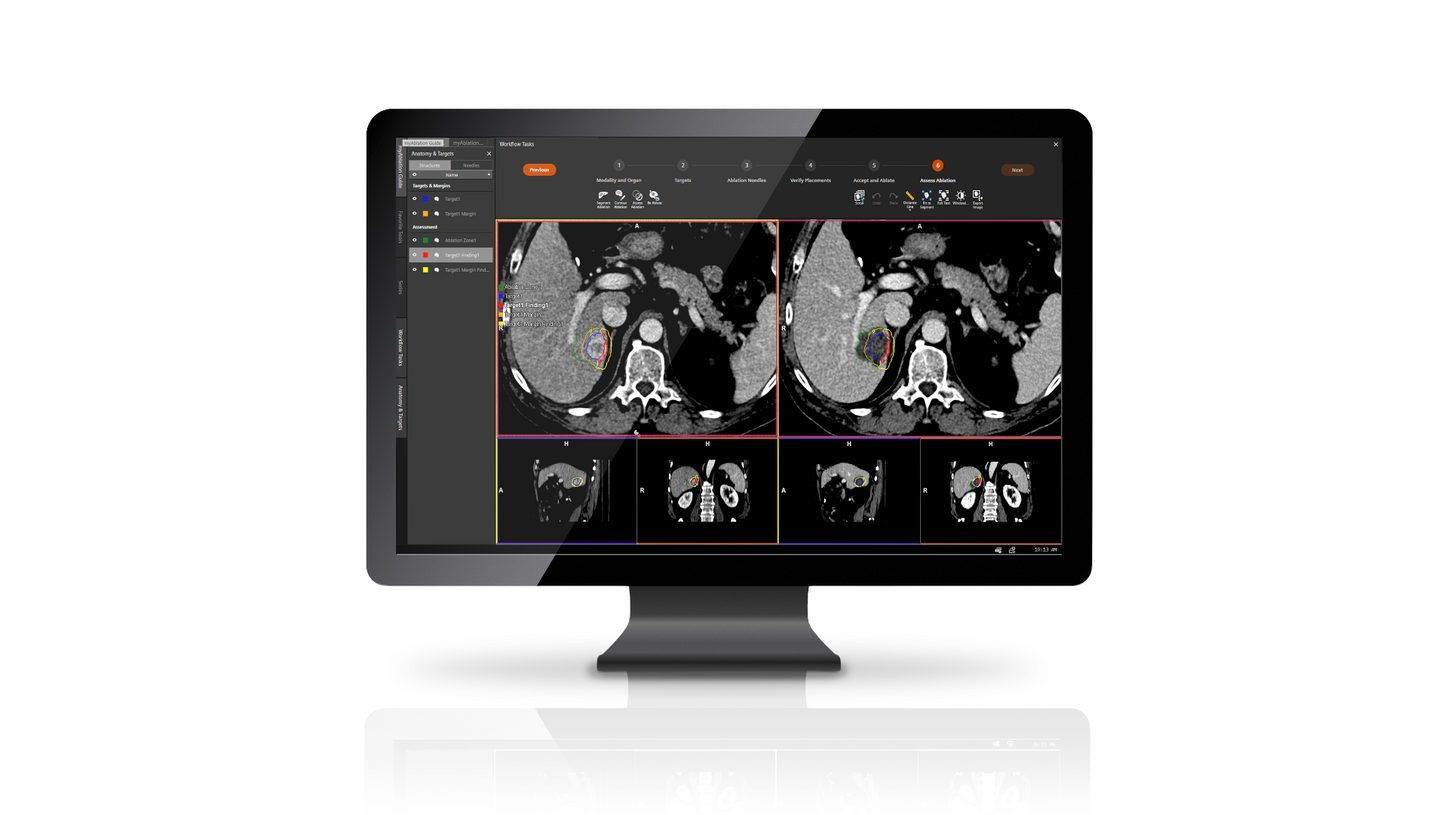 myAblation Guide