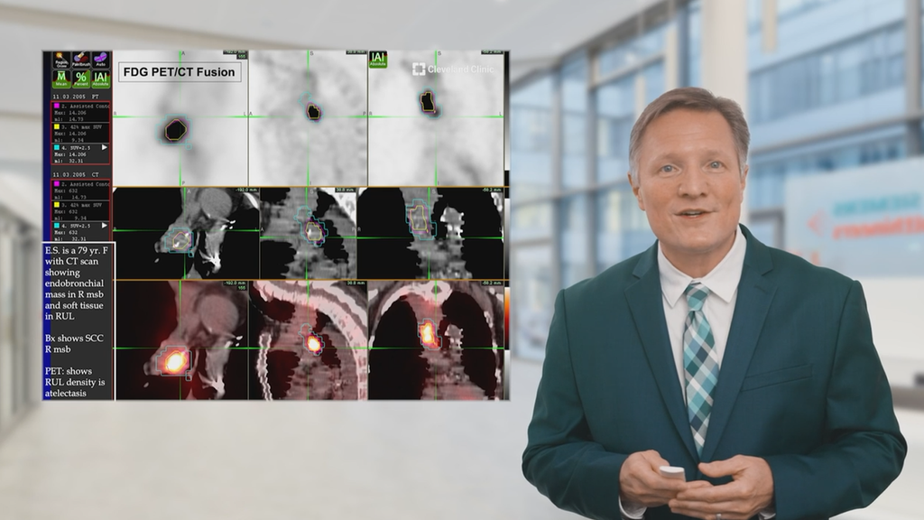 Webinar - The Value of PET/CT in Radiation Therapy