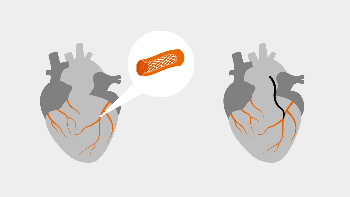 siemens-healthineers_perspectives_coronary_artery_disease_patient_story_revascularization