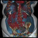 Bariatric Abdomen