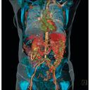 Thorax Abdomen CTA <br /><br />