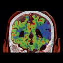 Whole Brain Perfusion