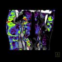 Volume Perfusion – Neck Tumor