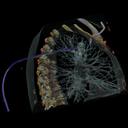 RF Ablation