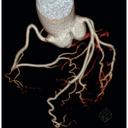 Coronary CTA
