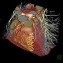Bariatric Coronary CTA