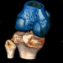 Knee Fracture