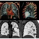Thorax Lung Tumor