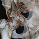 Pelvis Fracture
