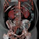 Abdomen CTA Stent