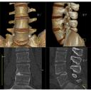 Lumbar Spine