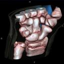 Wrist Epiphysis