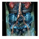 Aortic Aneurysm CTA