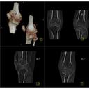 Bilateral Knee Fracture