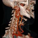 Carotid CTA<br />