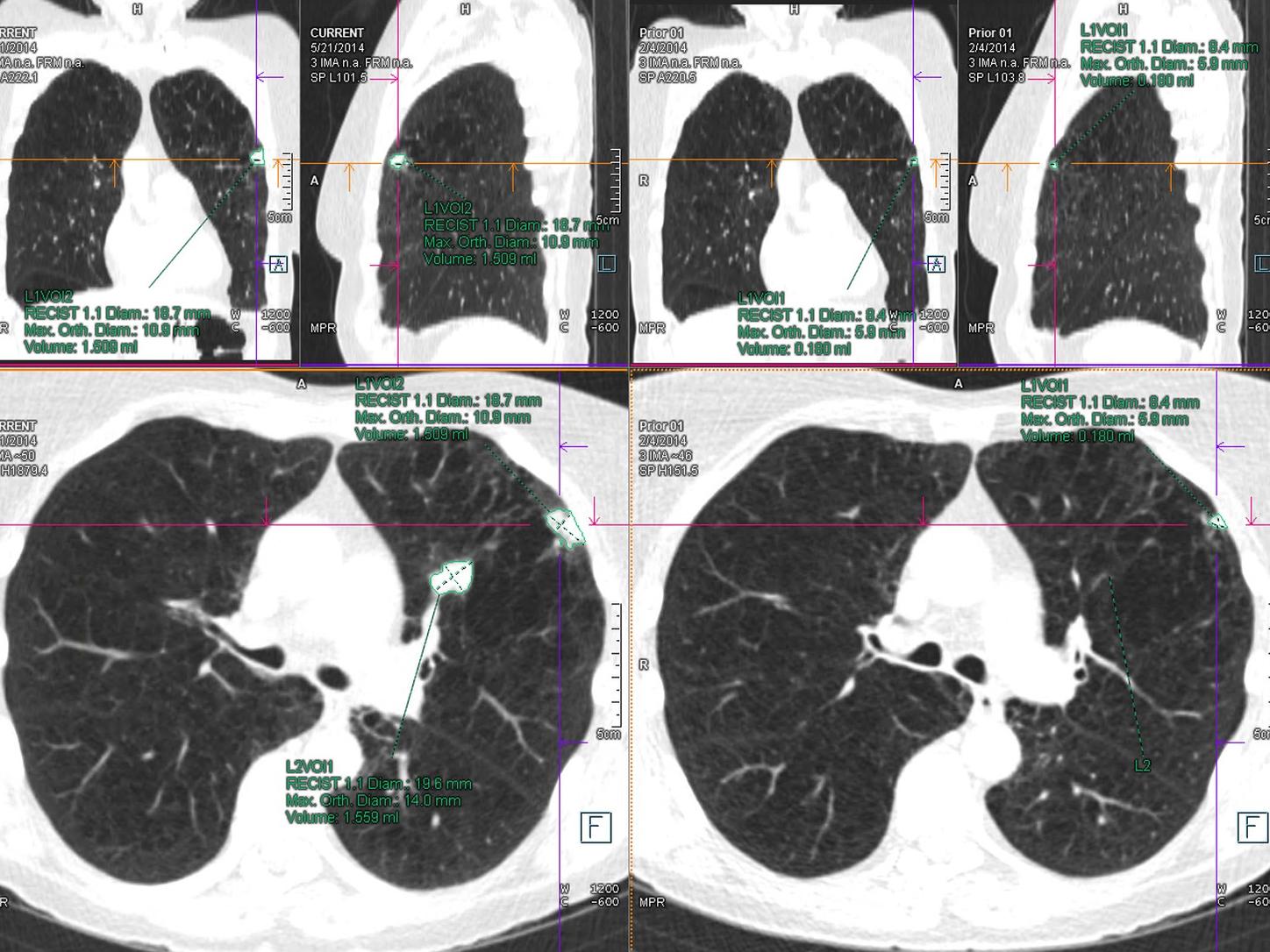 Computed Tomography &amp; syngo.via - Lung cancer therapy monitoring