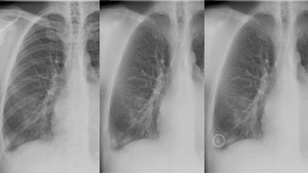 X-ray products  - Lung cancer screening
