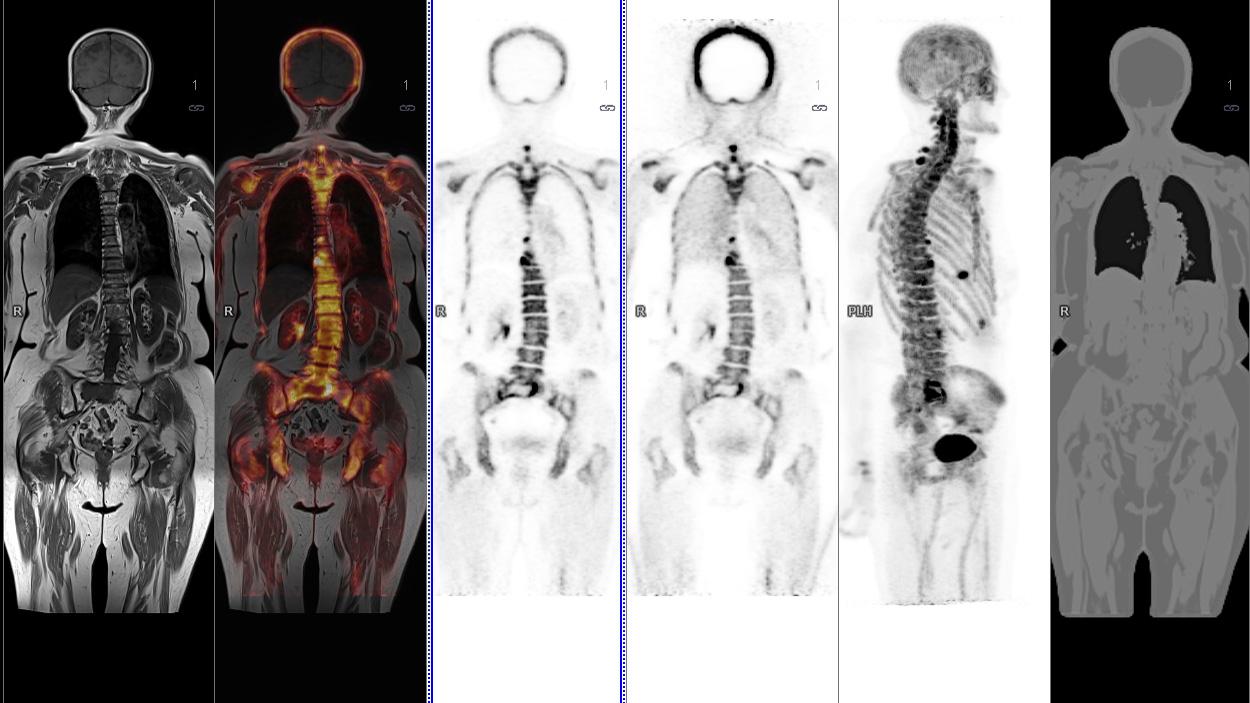 Magnetic Resonance Imaging (MRI) and Molecular MR (MR/PET)&nbsp; - Lung cancer screening
