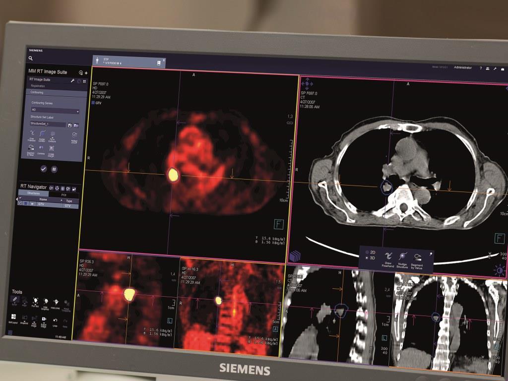 Lung cancer screening -  Image reading and reporting with syngo.via