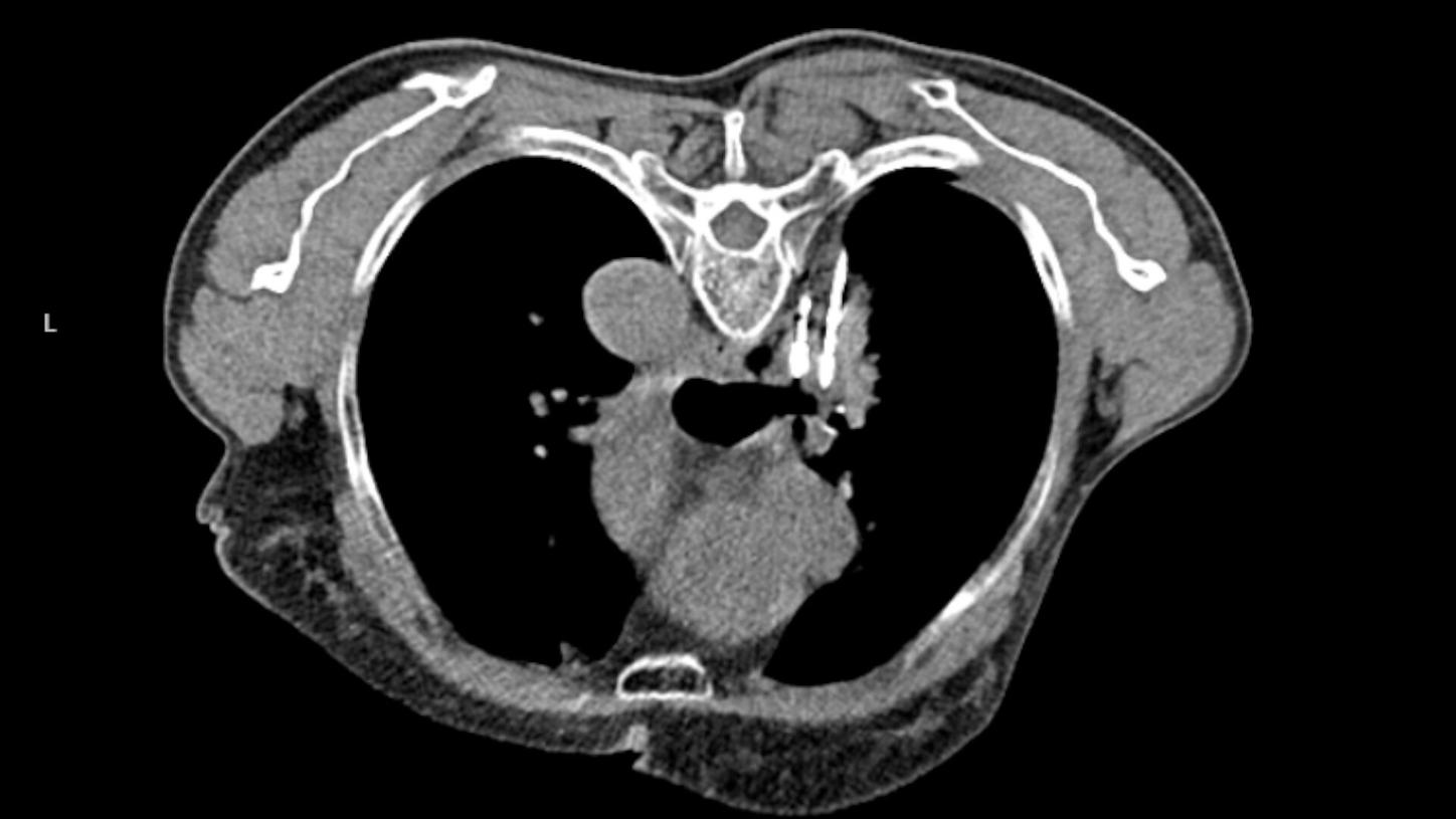 lung cancer iMar