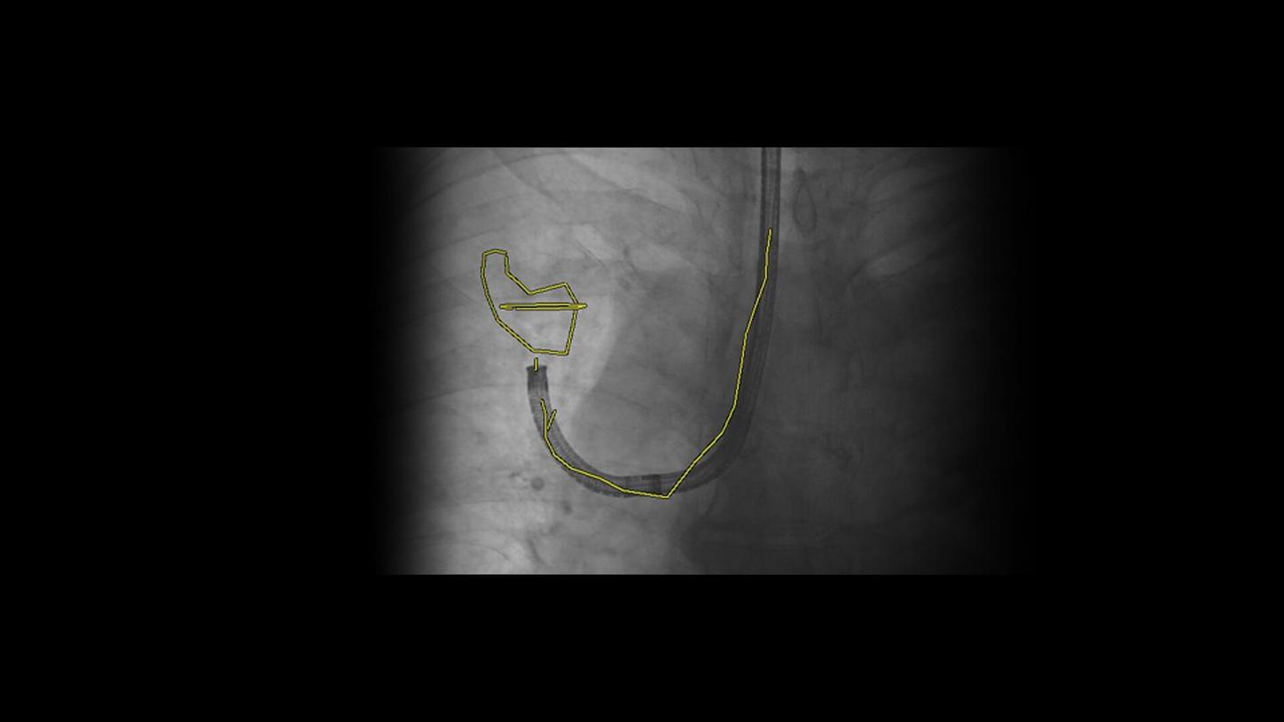 Image-guided endobronchial interventions