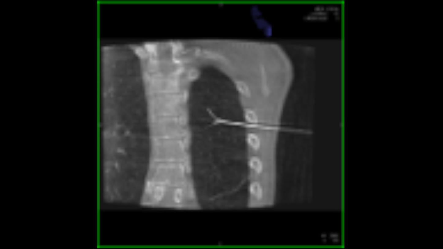 percutaneous lung cancer