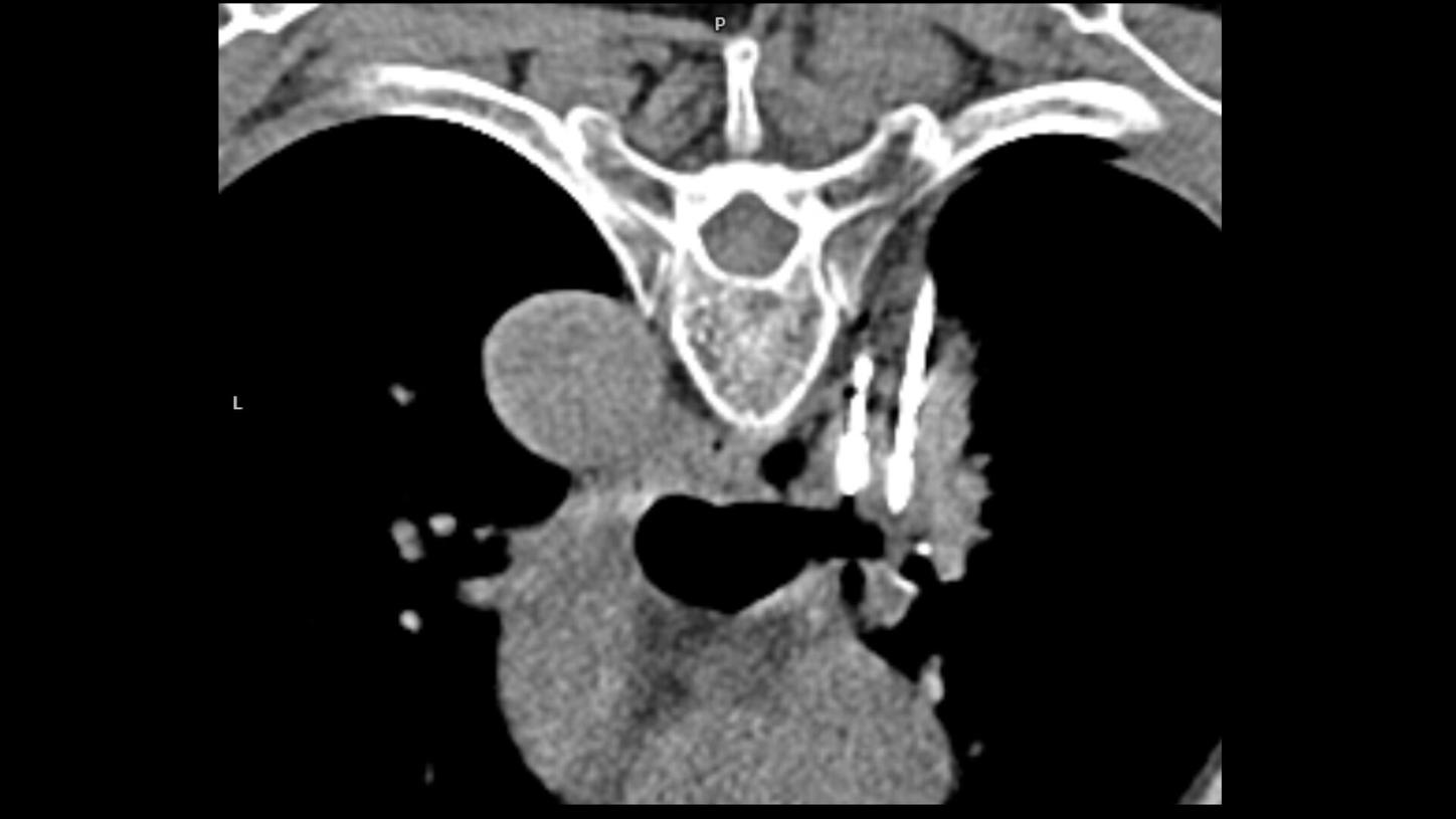 lung cancer iMar